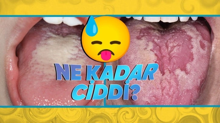 Dilde Beyazlık Neden Olur?