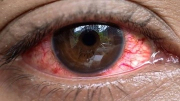 Uganda'da salgın: 7 bin 500 kişide &#8220;kırmızı göz&#8221; hastalığı görüldü